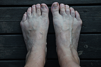 Bunion side online of foot