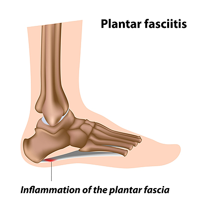 Foot arch on sale heel pain