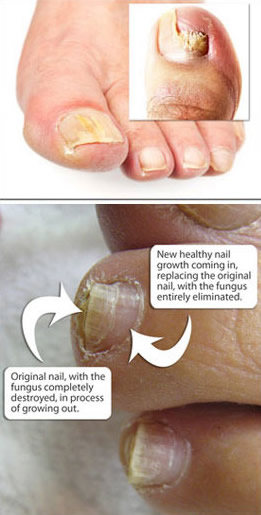 Natural Remedy for Toenail Fungus - Cultured Palate