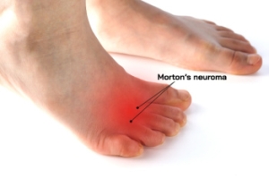 What Causes Pain in the Ball of the Foot?