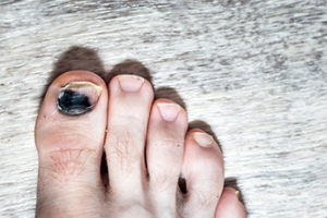 Ways to Avoid Toenail Problems in Running