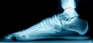 Flexible Flat Feet Is Common in Babies