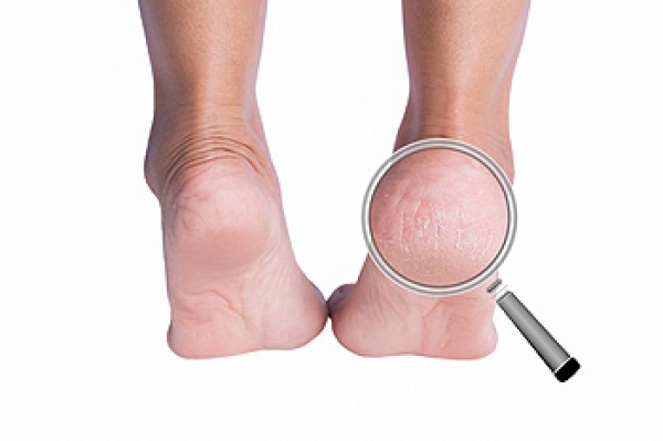 Dry Feet & Cracked Heels: Causes & Treatment - Foot and Ankle Group