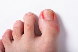 Causes of an Ingrown Toenail