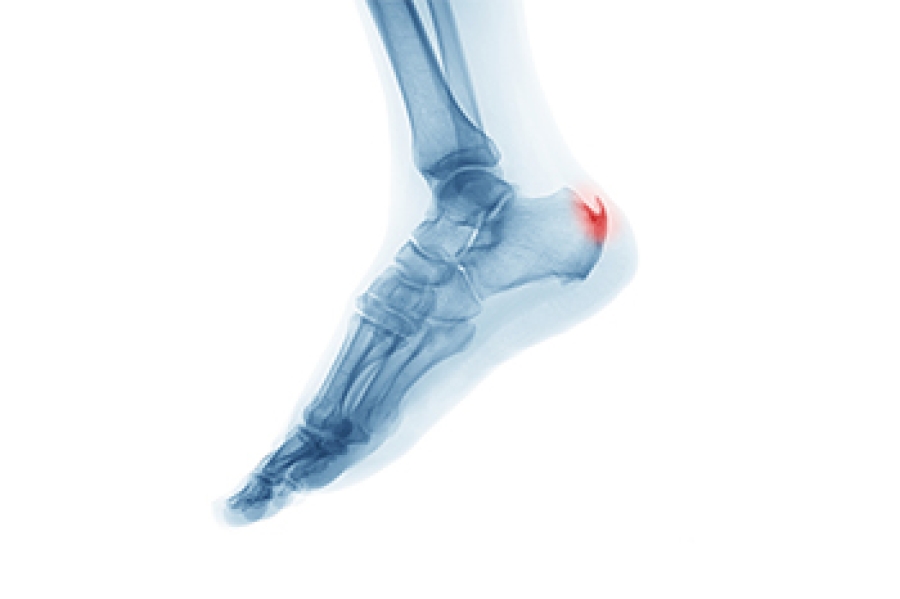 Heel Spur Surgery - Premier Podiatry: Velimir Petkov, DPM: Podiatrists:  Clifton, NJ